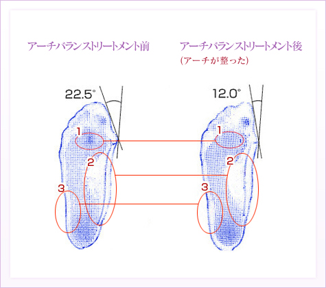 外反母趾施術